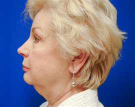 Facelift Patient Before Photo