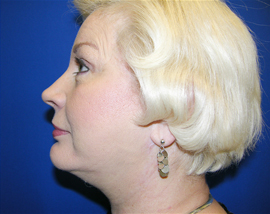 Facelift Patient After Photo