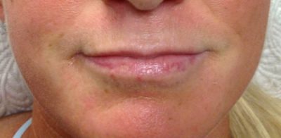 Juvéderm Patient Before Photo Nashville