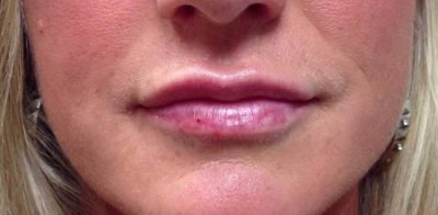 Juvéderm Patient After Photo Nashville