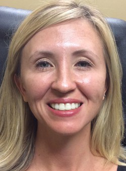 BOTOX Patient After Photo Nashville