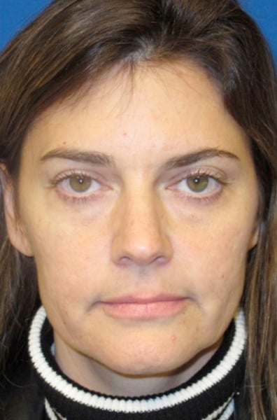 Restylane Patient Before Photo