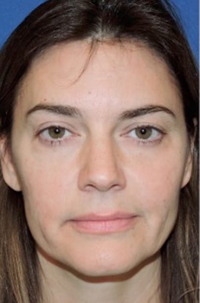 Restylane Patient After Photo