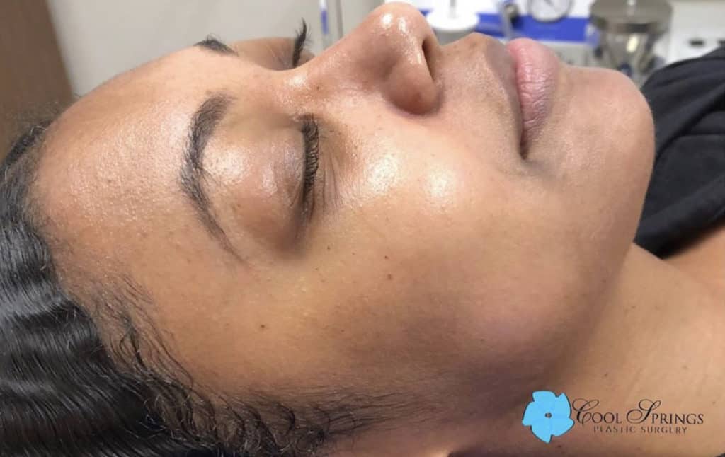 HydraFacial Patient After Photo