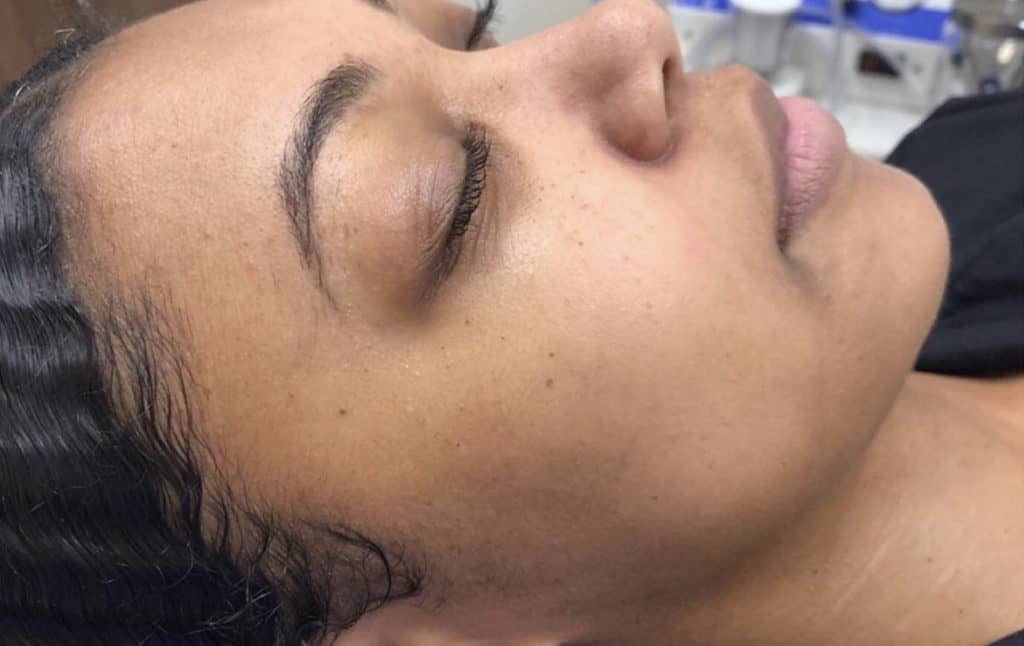 HydraFacial Patient Before Photo Nashville