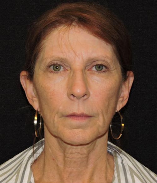 Eyebrow Lift Patient Before Photo
