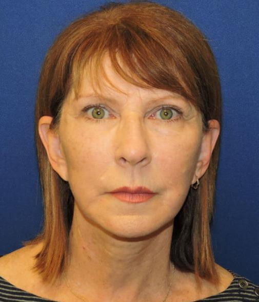 Eyebrow Lift Patient After Photo