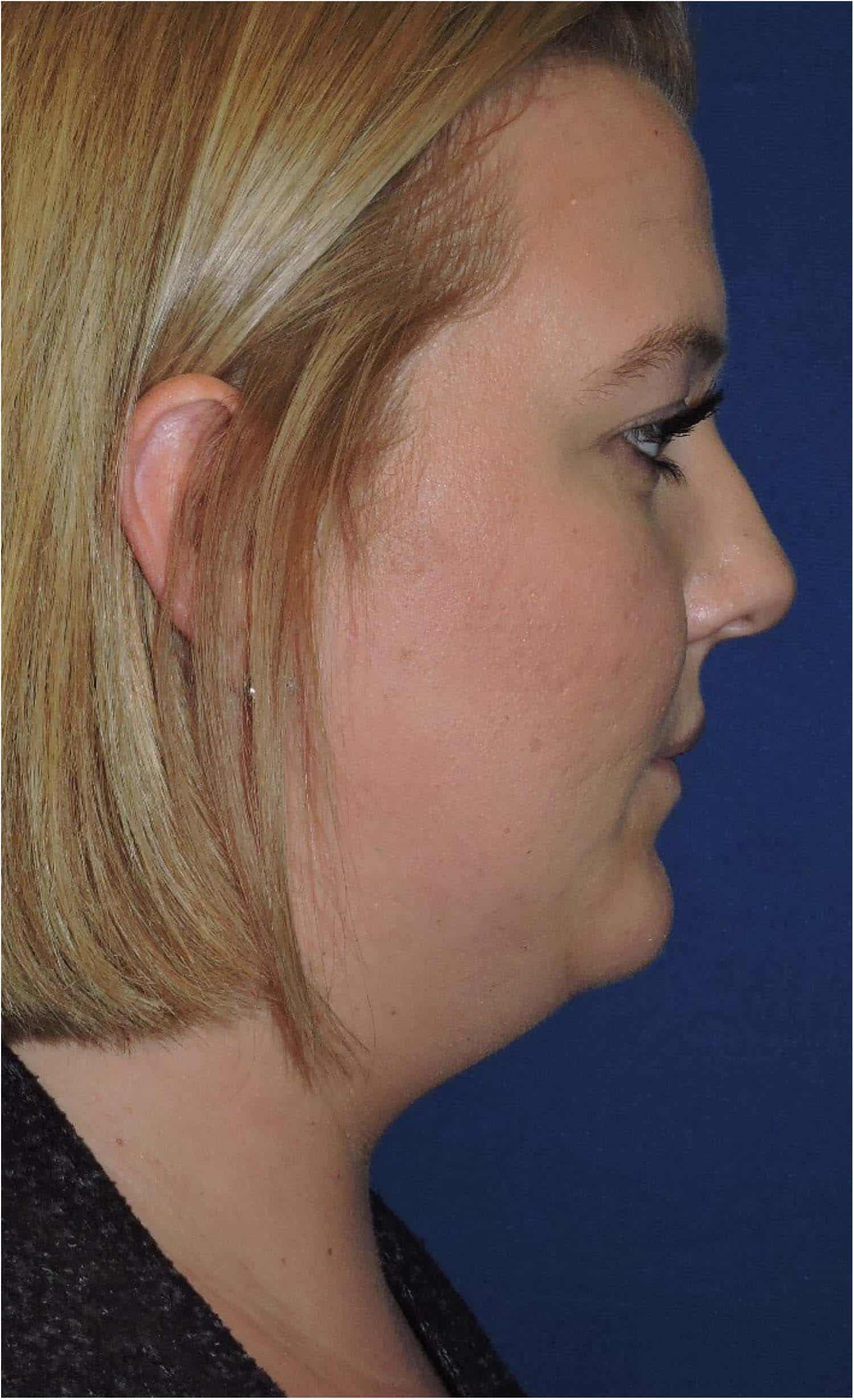 Kybella Patient Before Photo