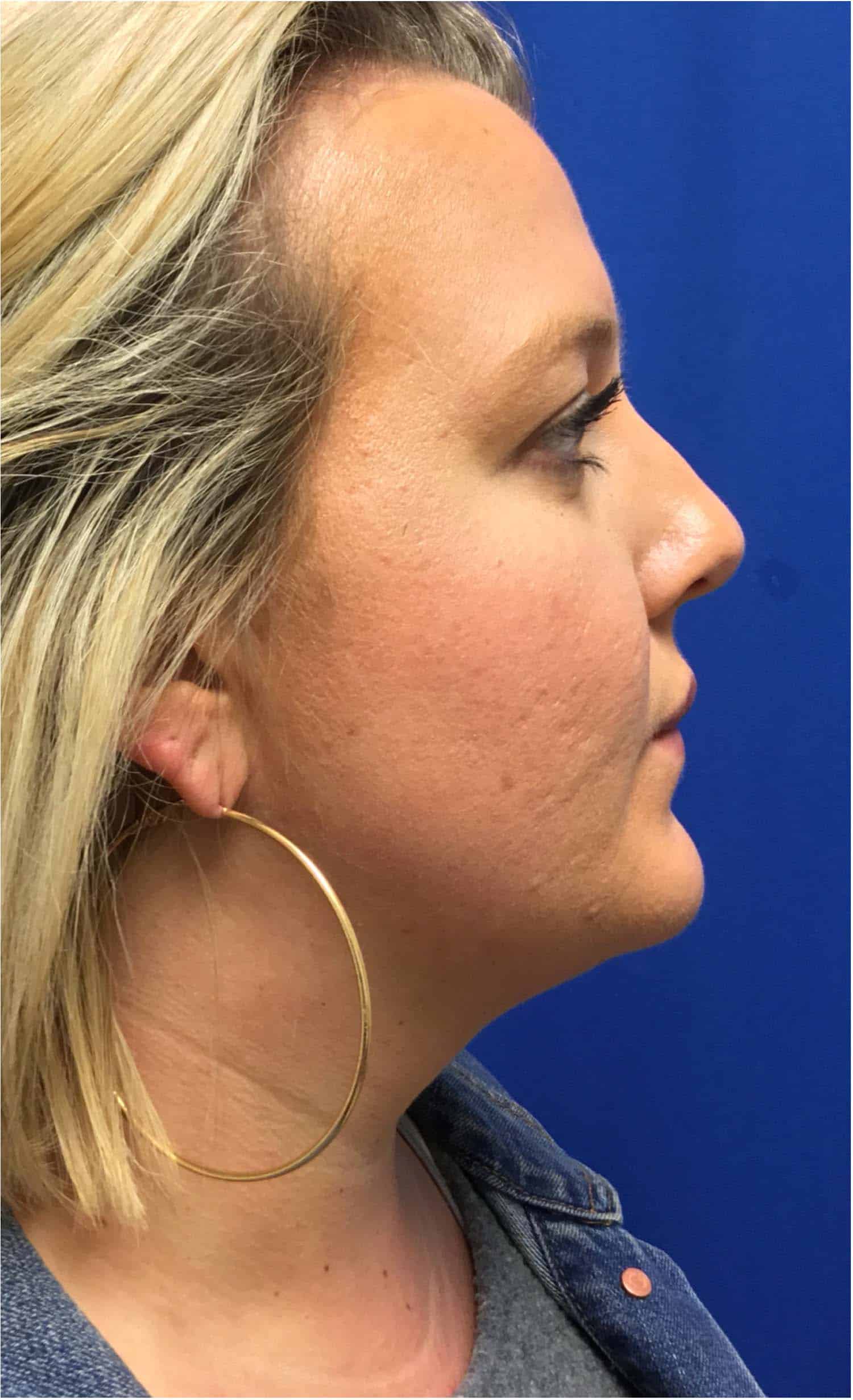 Kybella Patient After Photo