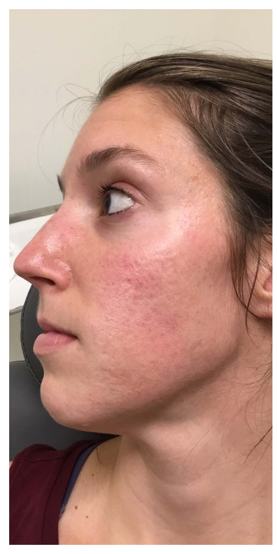 Microneedling Patient Before Photo
