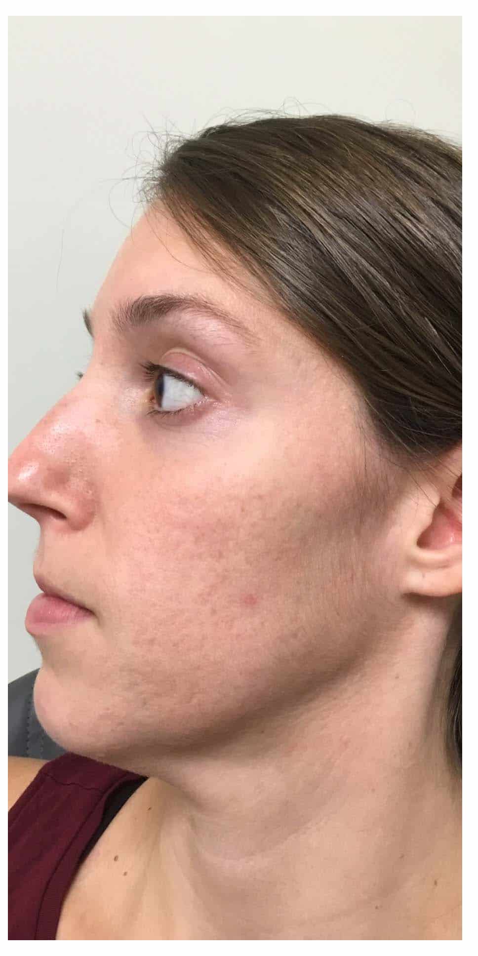 Microneedling Patient After Photo