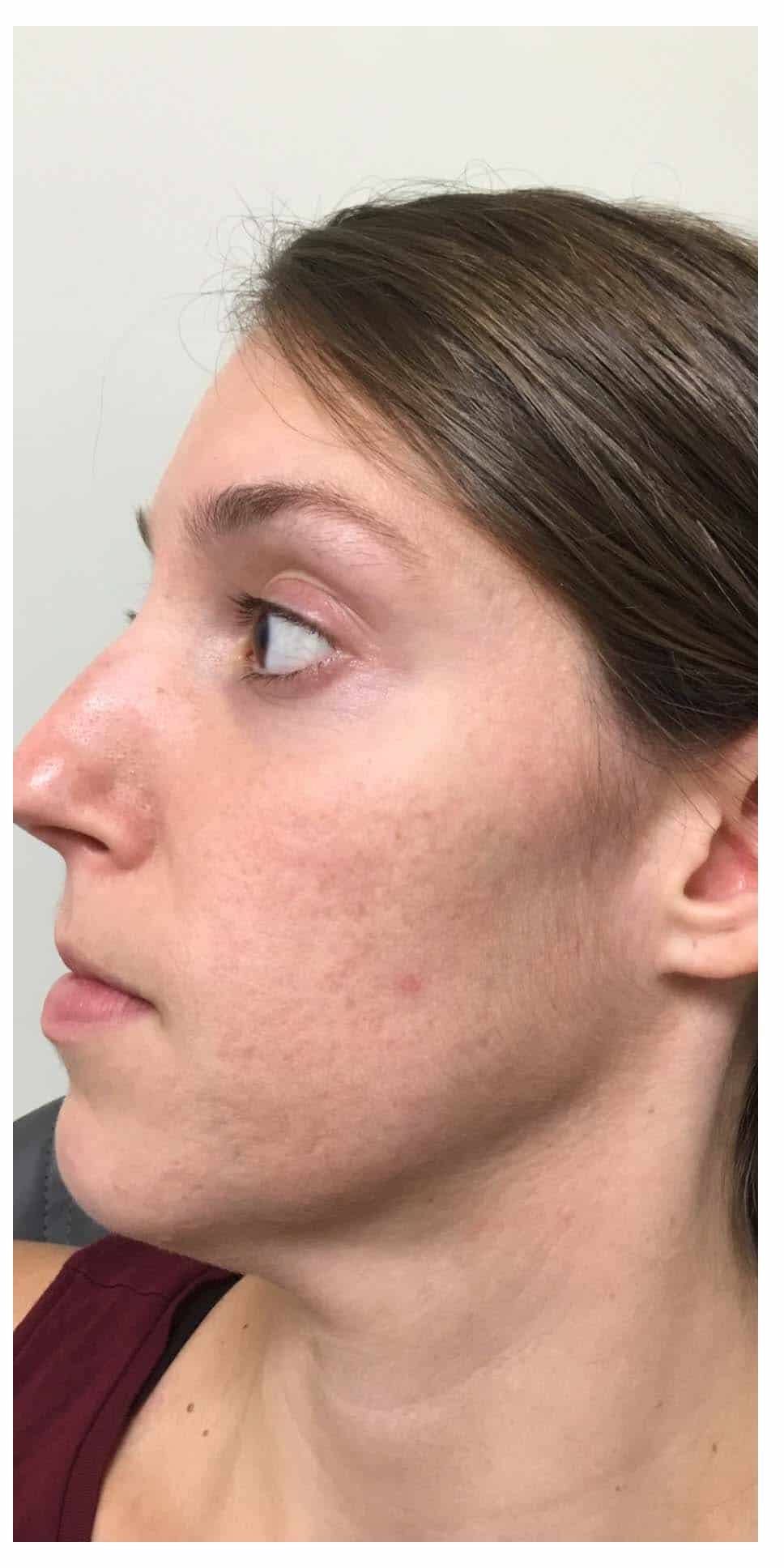 Microneedling Patient After Photo Nashville