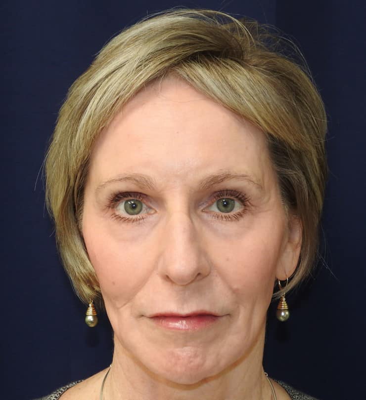 Contour TRL Patient After Photo Nashville