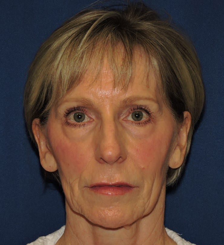 Contour TRL Patient Before Photo Nashville