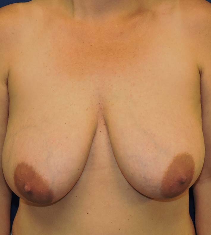 Breast Lift Patient Before Surgery Photo at CSPS