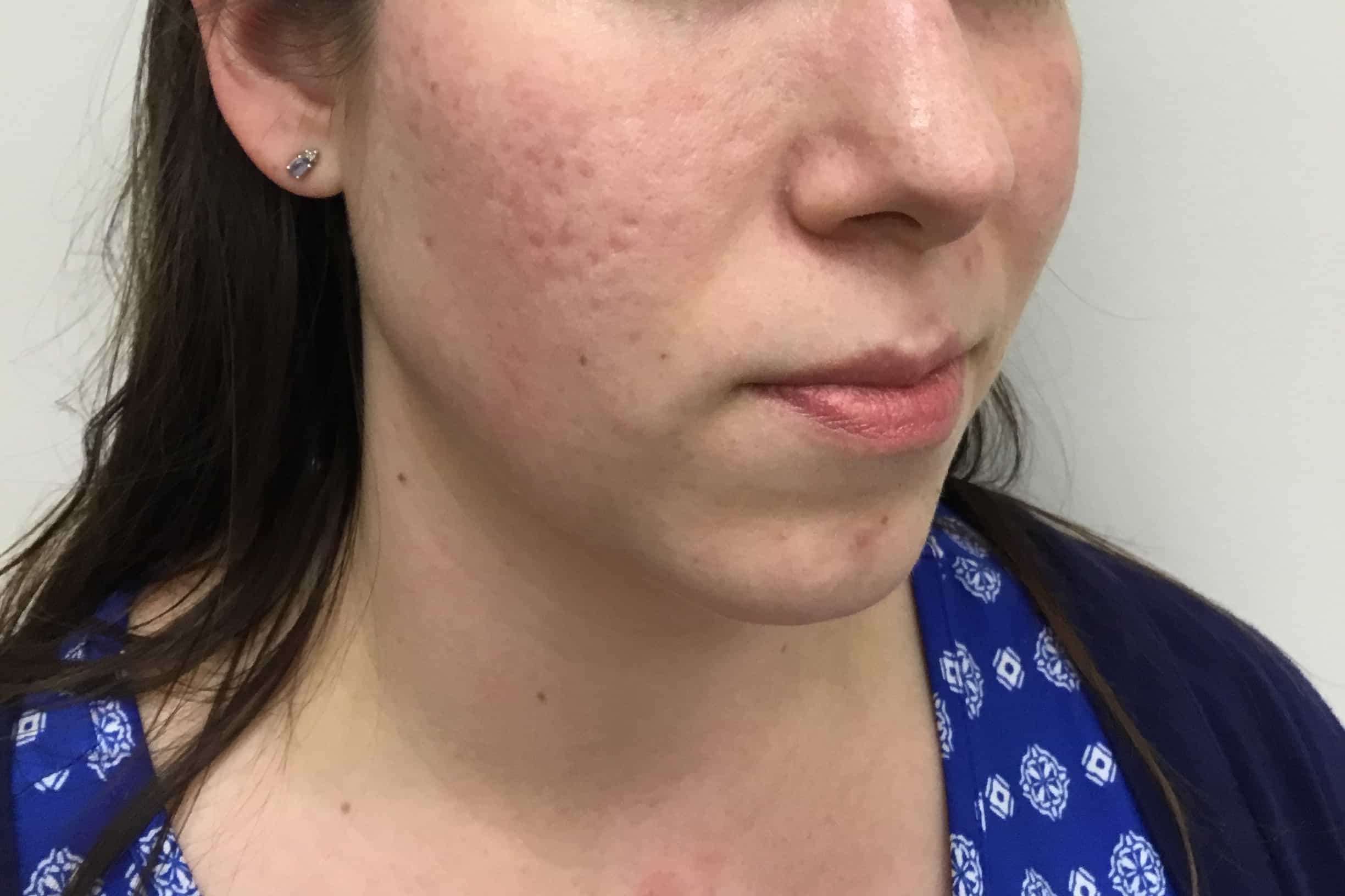 Halo Laser Patient Before Photo Nashville