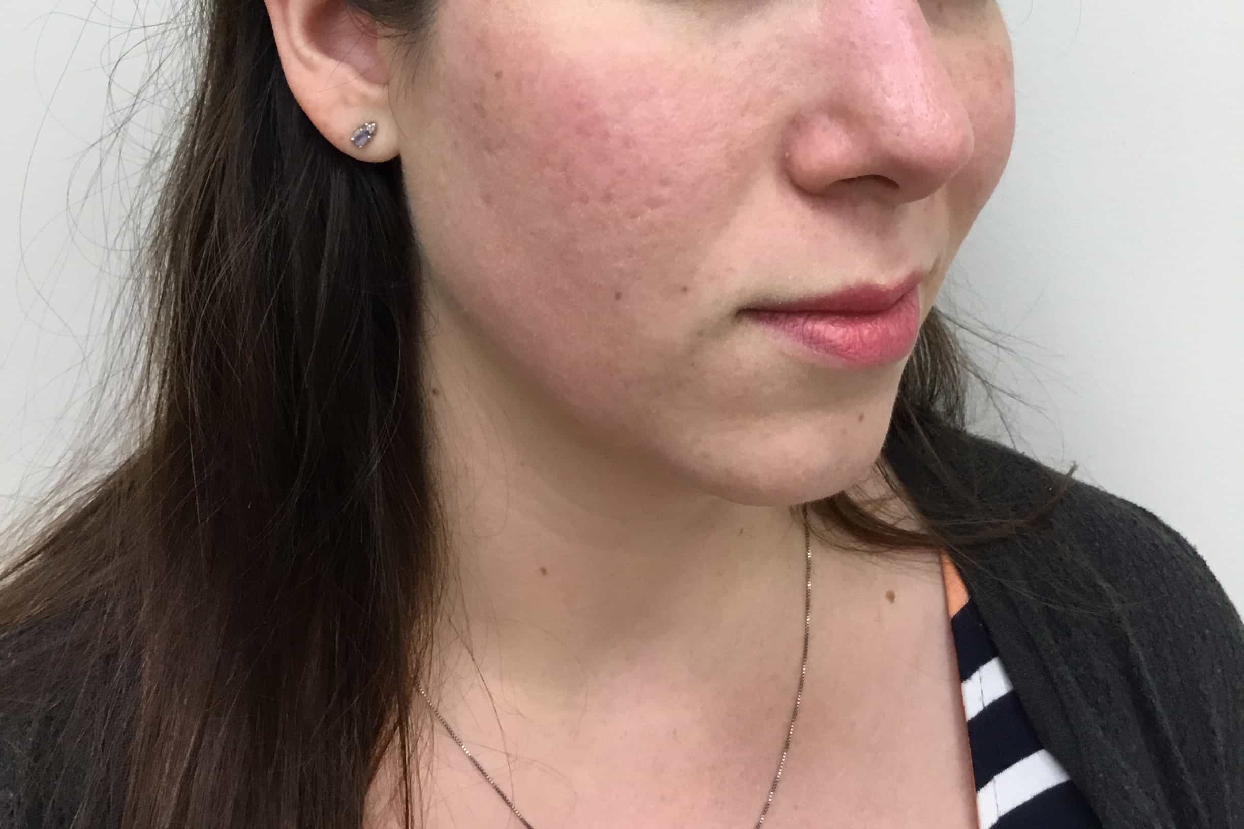 Halo Laser Patient After Photo Nashville