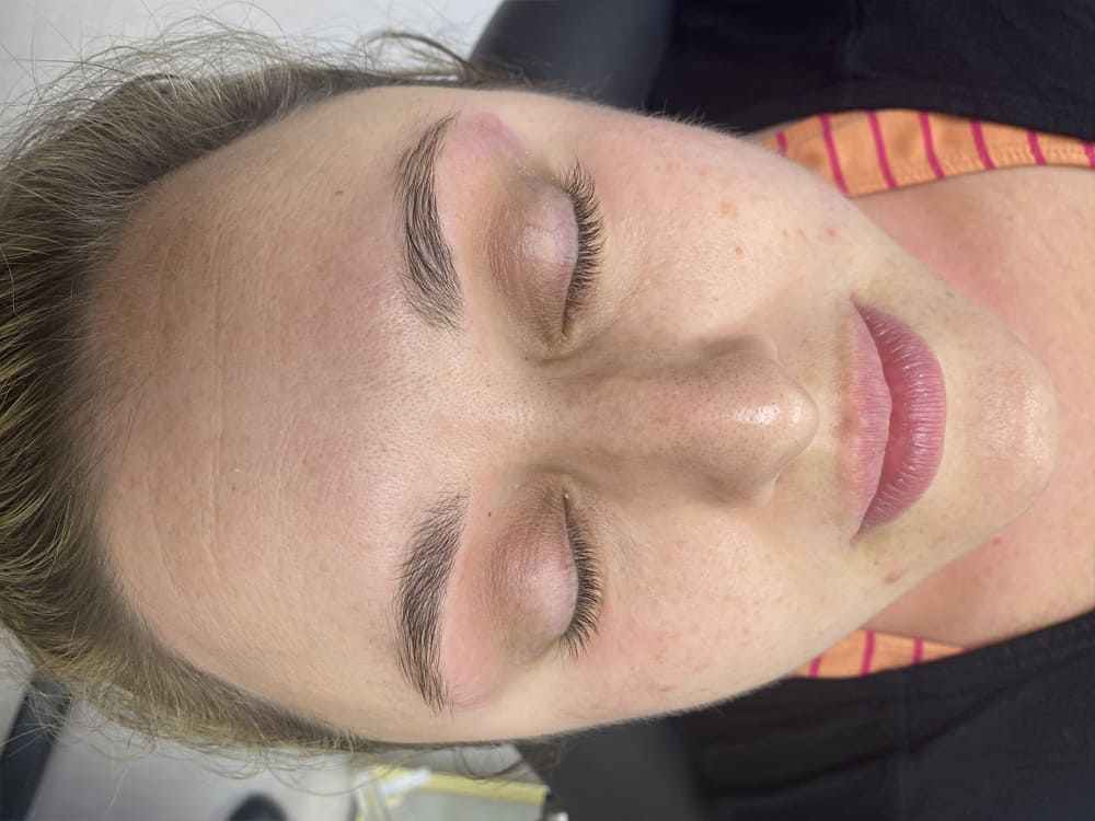 Dermaplaning Patient Before Photo