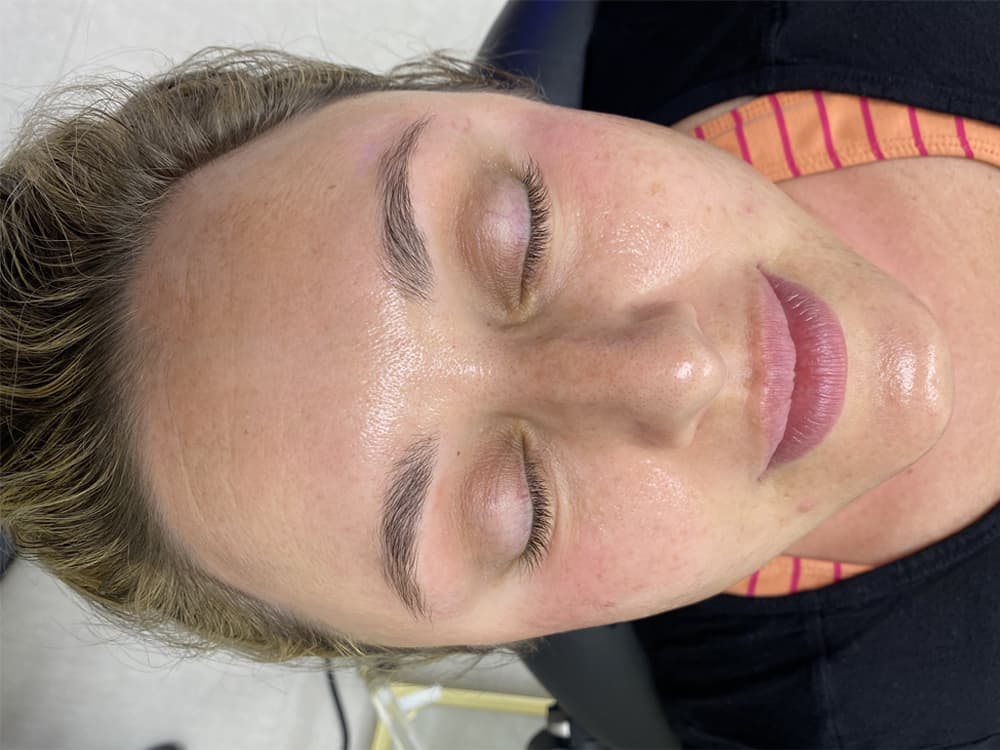 Dermaplaning Patient After Photo