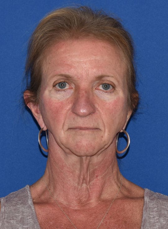 Facial Fat Grafting Patient Before Photo Nashville