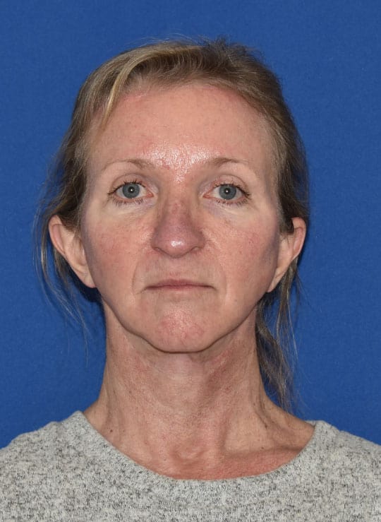 Facial Fat Grafting Patient After Photo Nashville