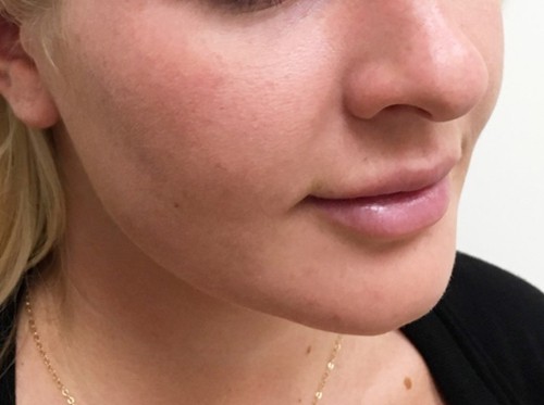 NanoLaserPeel Patient After Photo Nashville