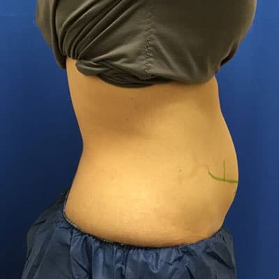 CoolSculpting Patient Before Photo