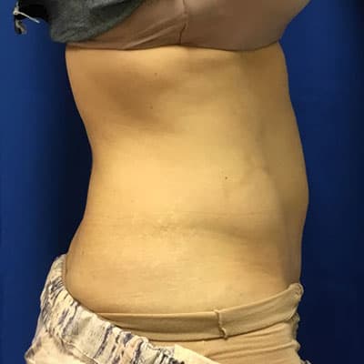 CoolSculpting Patient Before Photo