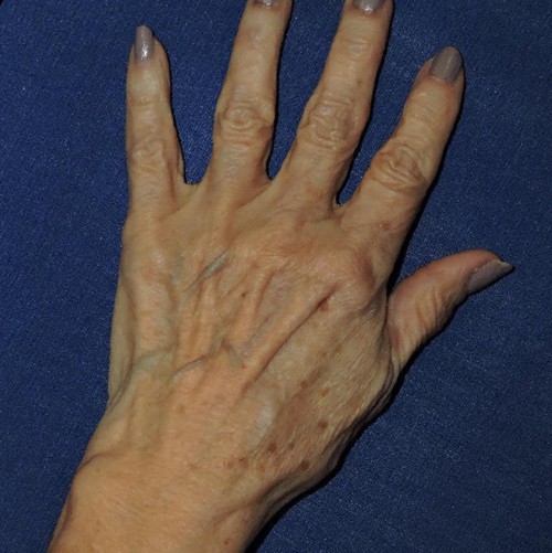 Hand Rejuvenation Patient Before Photo