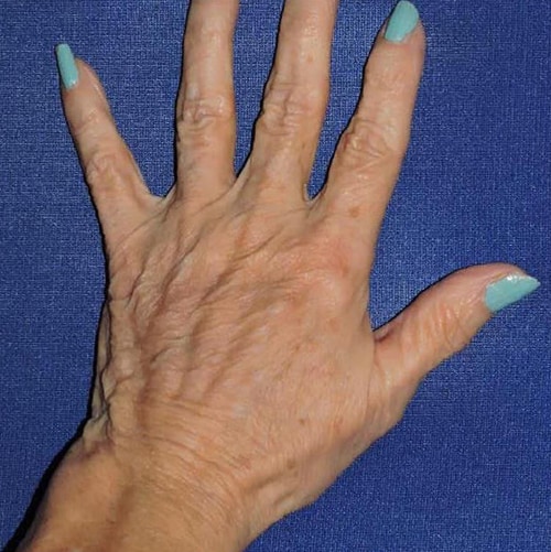 Hand Rejuvenation Patient After Photo