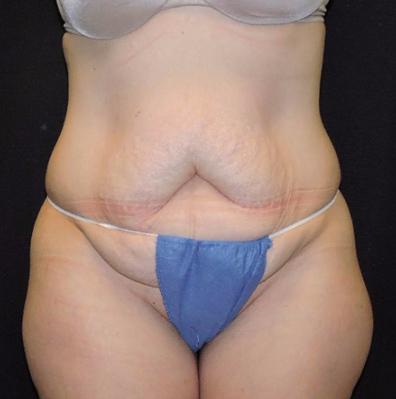 Tummy Tuck Patient Before Photo