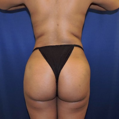 After Brazilian Butt Lift Nashville