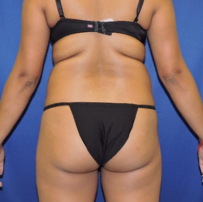 Before Brazilian Butt Lift Nashville