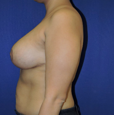 Breast Implant Revision Patient After Photo