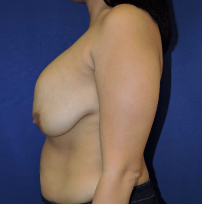 Breast Implant Revision Patient Before Photo