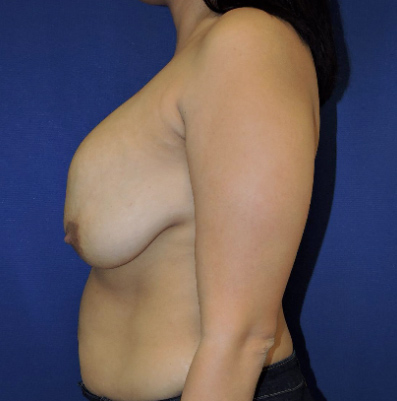 Breast Implant Revision Patient Before Photo Nashville