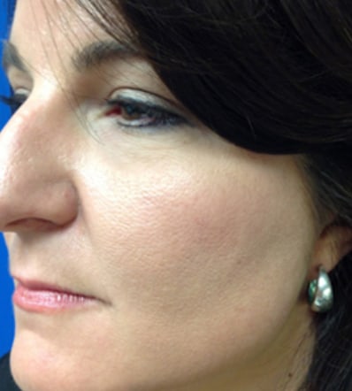 Chemical Peel Patient After Photo Nashville