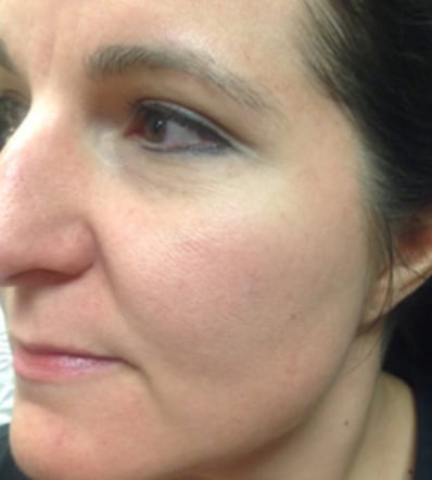 Chemical Peel Patient Before Photo