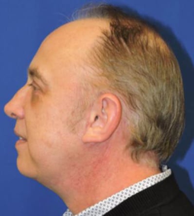 Chin Implants Patient After Photo