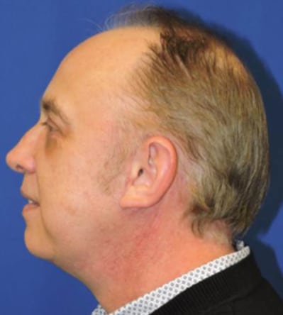 Chin Implants Patient After Photo Nashville
