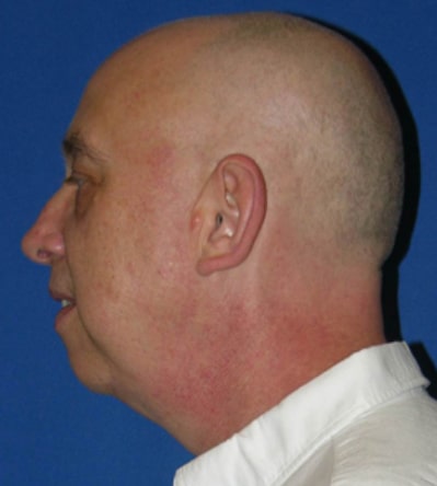 Chin Implants Patient Before Photo