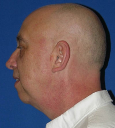 Chin Implants Patient Before Photo Nashville