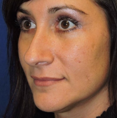 After Blepharoplasty Nashville