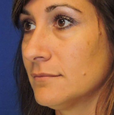 Before Blepharoplasty Nashville