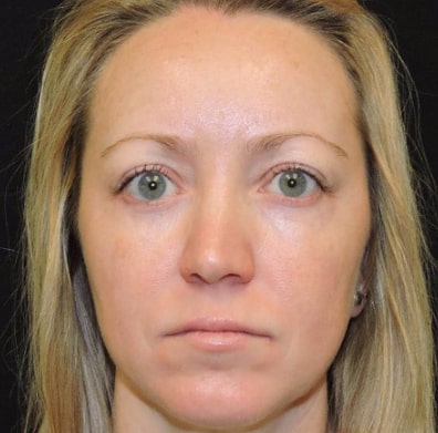 Laser Skin Resurfacing Patient After Photo