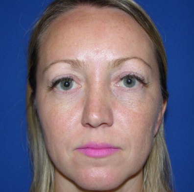 Laser Skin Resurfacing Patient Before Photo