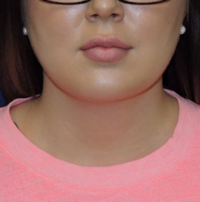 Chin Liposuction Patient After Photo