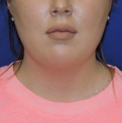 Chin Liposuction Patient Before Photo
