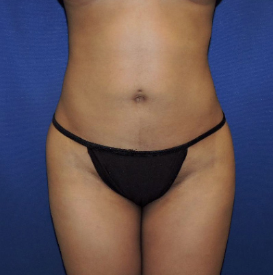 Liposuction Patient Before Photo