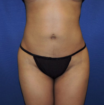 Liposuction Patient After Photo Nashville